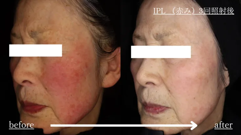 施術所名:IPL 3回 リスク・副作用:一時的な赤みや・腫れがあります