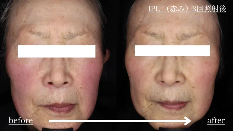 施術所名:IPL 3回 リスク・副作用:一時的な赤みや・腫れがあります