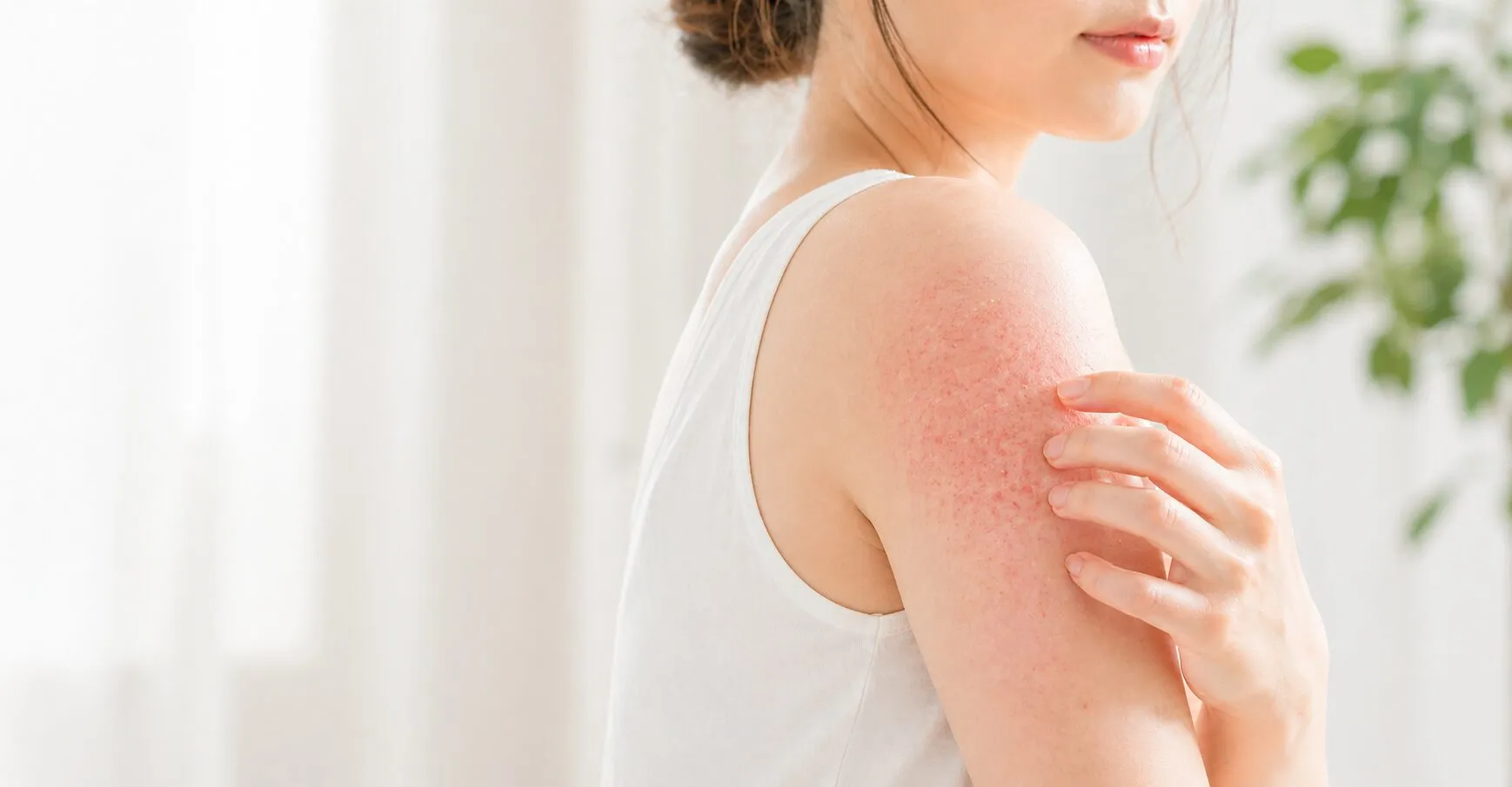 アトピー性皮膚炎