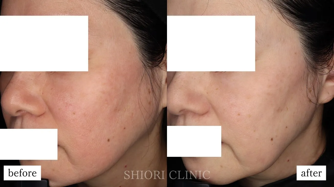 キュアジェット全顔症例写真 拡大