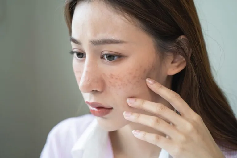 脂漏性角化症