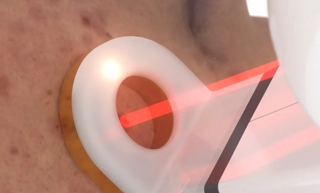 皮脂腺に作用するレーザー